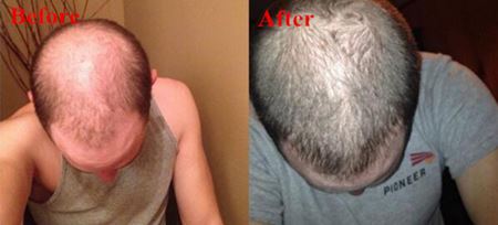 anti-hair loss