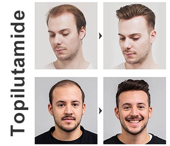 Ne dopustite da se za gubitak kose više krivi ostajanje do kasno