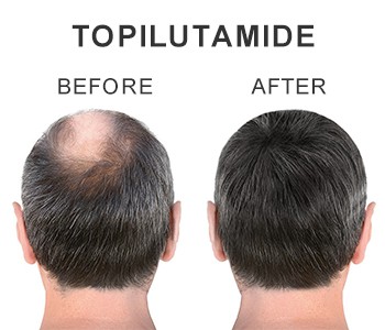 Prepisivanje za 250 milijuna pacijenata s gubitkom kose koji se suočavaju s p...