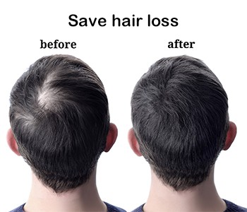 Ćelav--često je mlađi, a androgena alopecija je najčešća