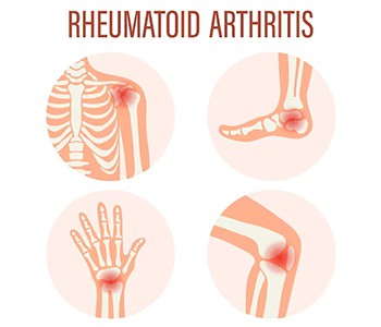 Naučimo više o znanstvenoj prevenciji i liječenju osteoartritisa!